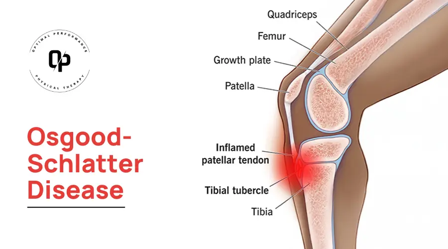 Osgood-Schlatter Disease - How and Where it Affects